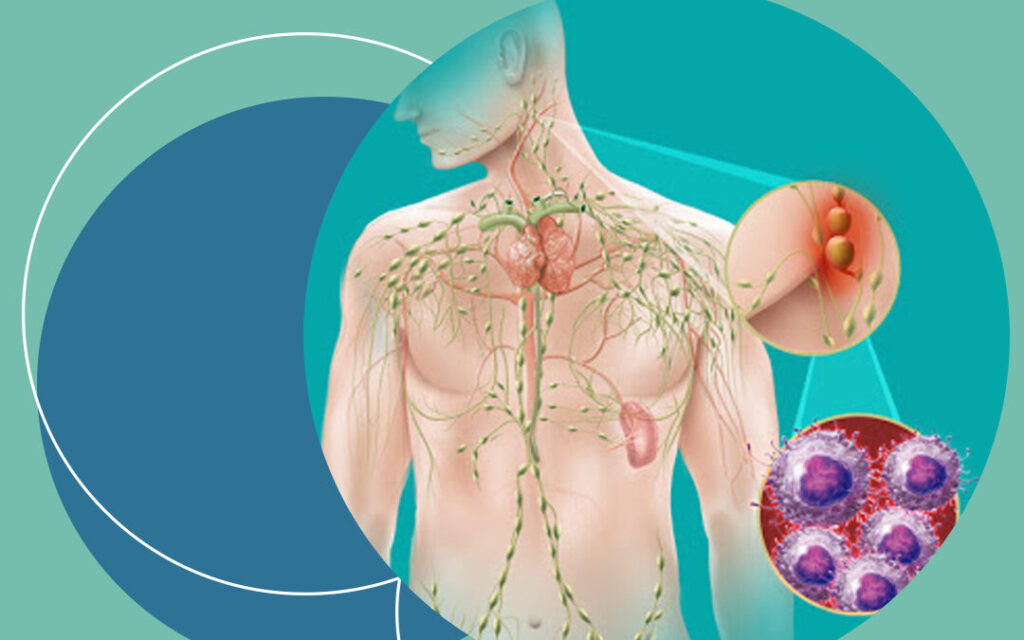 Explorando nuevas fronteras en la investigación del linfoma de Hodgkin