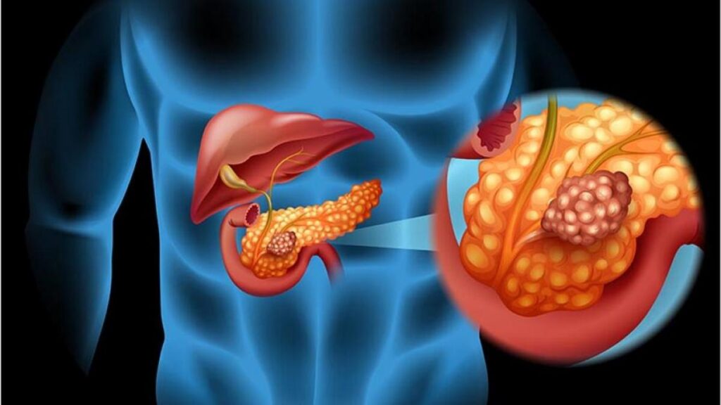 Nuevas investigaciones sobre el cáncer pancreático pueden mejorar la detección y el tratamiento