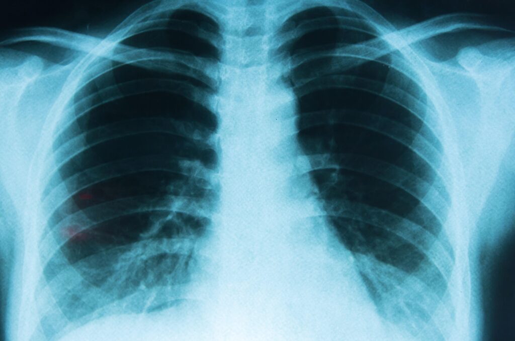 Identifican la célula clave que origina el cáncer de pulmón en fumadores