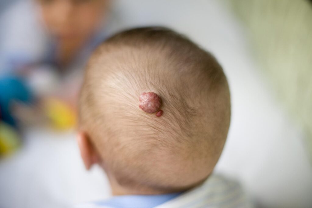 Descubren variantes genéticas poco comunes como posibles causas de tumores sólidos en niños