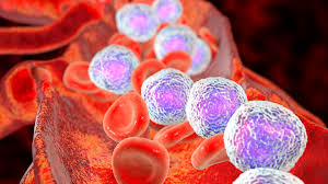Leucemia infantil- tratable, si se detecta a tiempo